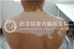 背部白癜风1.jpg