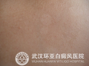 白癜风治不好是什么原因 5.jpg