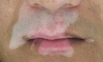 脸上长了白斑会是白癜风吗?