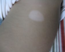 武汉白癜风是什么引起的?