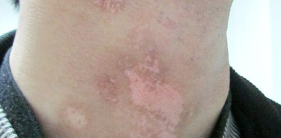 武汉白癜风的病因有哪些