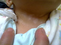 武汉儿童为什么会患有白癜风