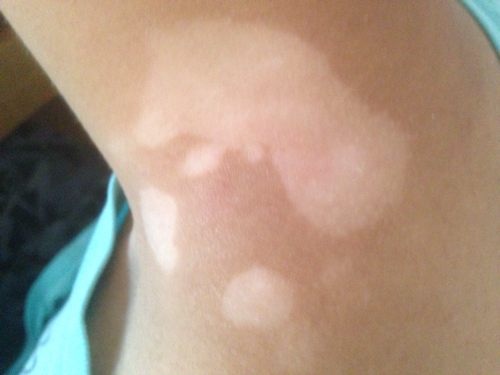 武汉专家分析白癜风的发病原因