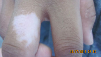 武汉白癜风形成的起因