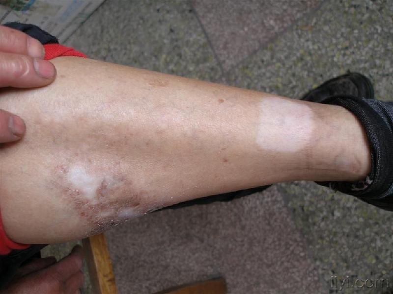 武汉白癜风是怎么引起的