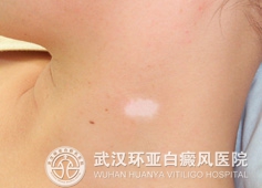 白癜风一般会有哪些好发部位 3.jpg