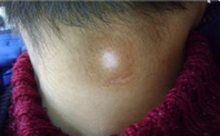 青少年患白癜风会给身心造成什么伤害 青少年患白癜风会给身心造成什么伤害