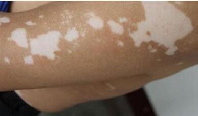 为什白癜风的白斑会变黑 为什白癜风的白斑会变黑