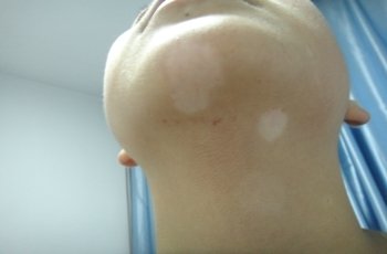 武汉小儿白癜风危害表现