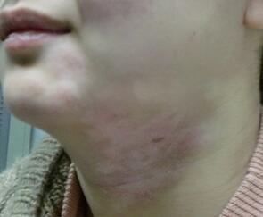 武汉白癜风的危害有多大