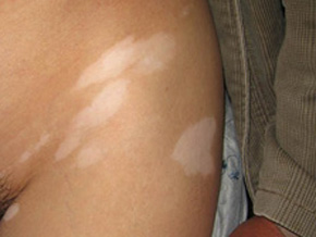 武汉白癜风对年轻人有什么危害