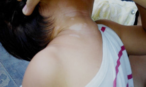 武汉小儿脸部白癜风危害