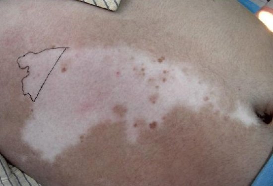 武汉白癜风对青少年身体危害