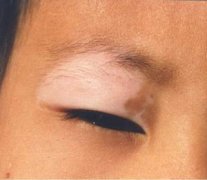 武汉白癜风对青年人心理的危害