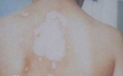 白癜风会对患者心理造成怎样的伤害呢? 白癜风会对患者心理造成怎样的伤害呢?