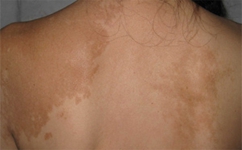 秋天白癜风要注意什么 秋天白癜风要注意什么