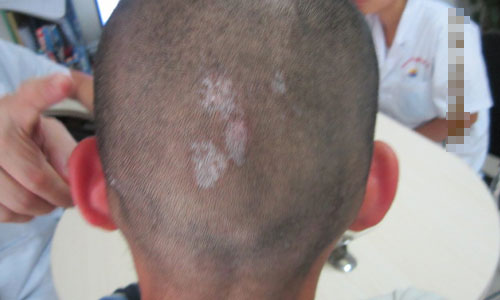 如何防止白癜风复发