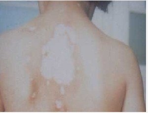 武汉白癜风的预防与治疗方法