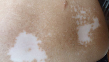 武汉怎样预防白癜风扩散?