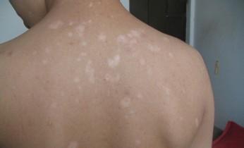 武汉如何预防小孩白癜风