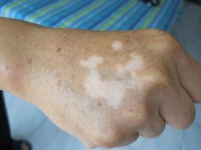 武汉白癜风应该如何预防