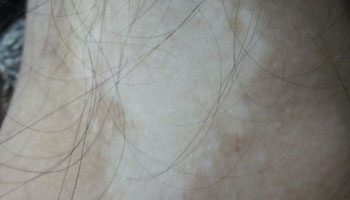 武汉白癜风的防治需要做什么