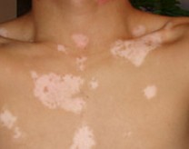 武汉如何有效地预防白癜风