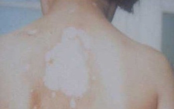 武汉白癜风预防和治疗