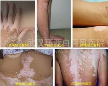 预防白癜风1.jpg