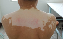 白癜风扩散是什么样子 白癜风扩散是什么样子