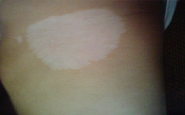 得了白癜风如何确诊 得了白癜风如何确诊