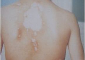 武汉白癜风常见诊断方式