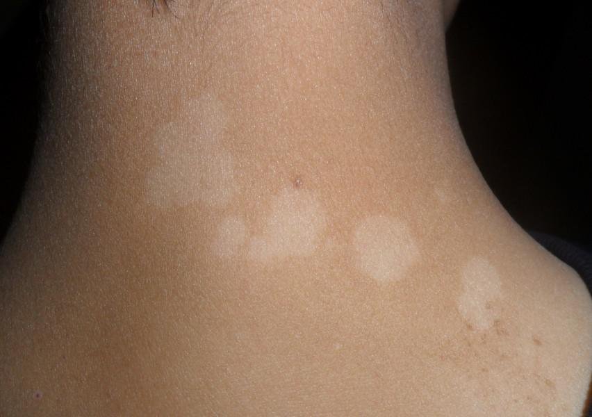 武汉有效诊断白癜风的方法有哪些呢