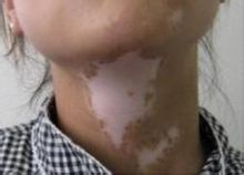 武汉如何正确诊断白癜风