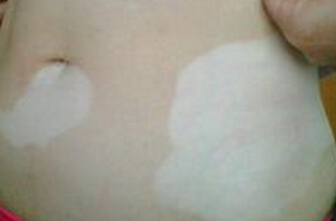 武汉白癜风的初期诊断有哪些