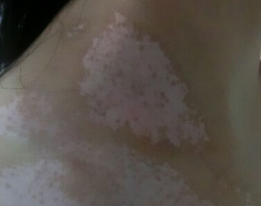 武汉临床上白癜风的诊断要点