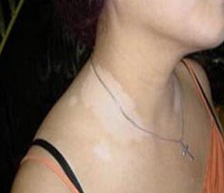 武汉青少年白癜风早期诊断