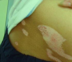 武汉确诊白癜风的主要依据