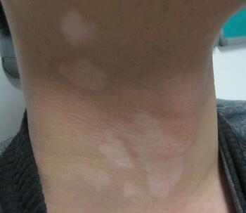 武汉白癜风诊断的重要性