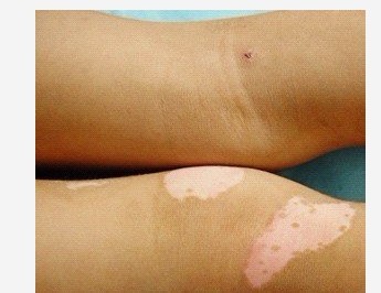 武汉儿童患上白癜风是因为什么