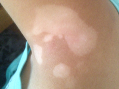 武汉我身上的白斑是怎么回事呢