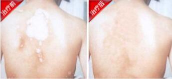 身上小白点武汉看白癜风的医院有哪些