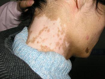 武汉白殿风治疗医院我的白斑居然自愈了