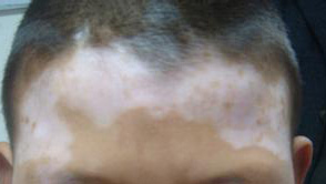 武汉白癫疯专科医院脸上有白斑怎么回事