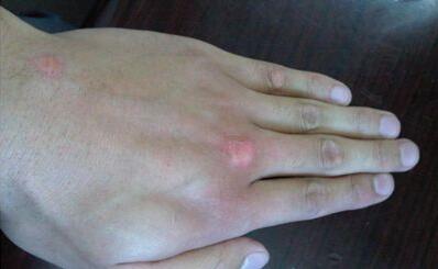 武汉环亚中医白癜医院白斑初期图