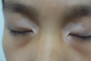 武汉白癜风医院哪个好白癜风早期症状图片