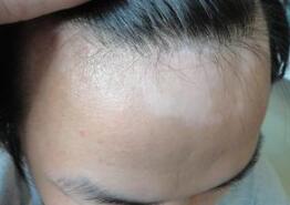 武汉治白癜风的医院轻度白癜风图片