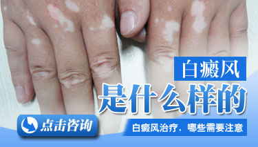 8.12 白癜风是什么样的.jpg