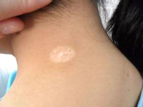 武汉早期白癜风怎么治效果好