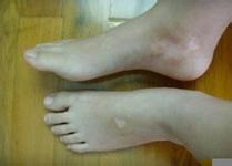 武汉女性患上白癜风能治吗